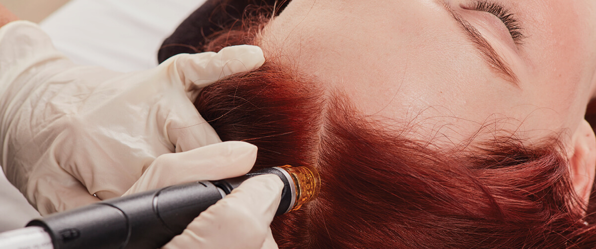 Keravive treatment for the scalp