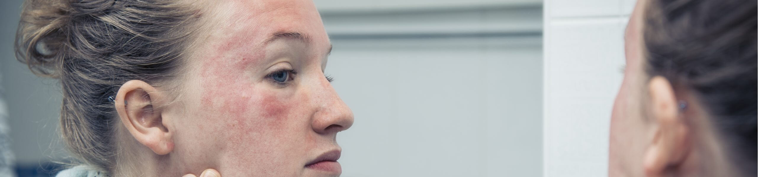 Woman with rosacea looking at the mirror