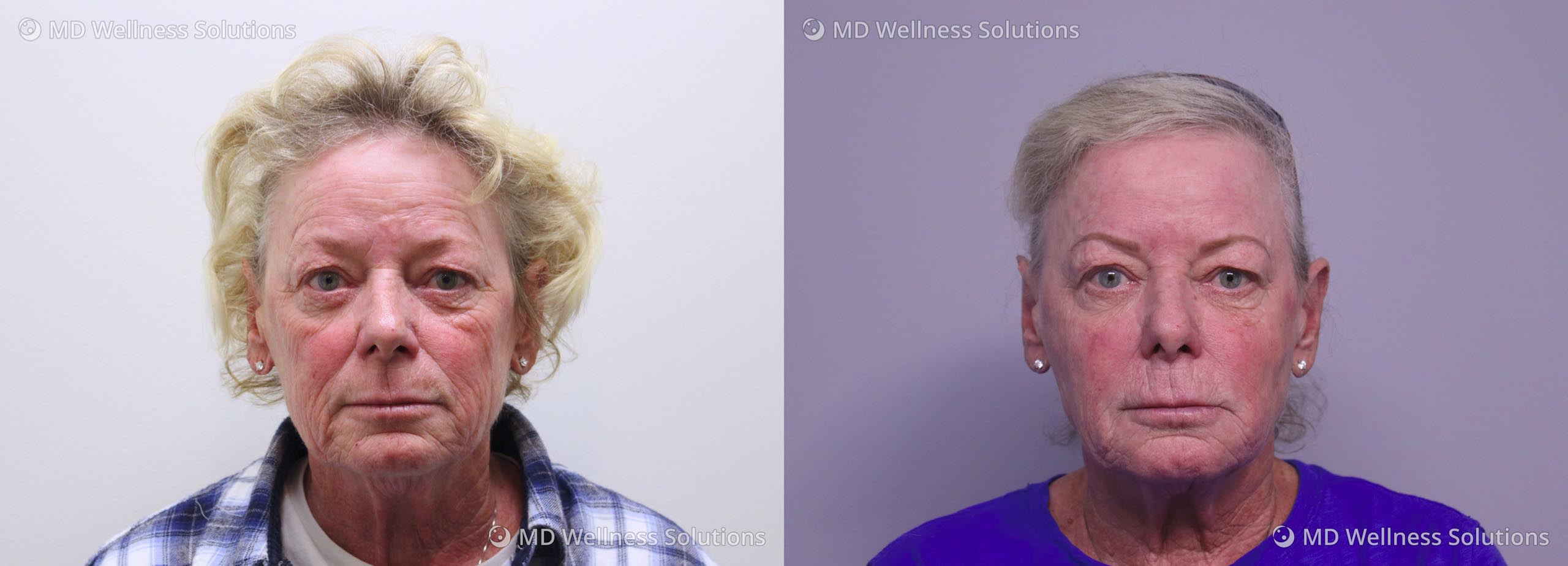 65-74 year old woman before and after neurotoxin and filler treatment
