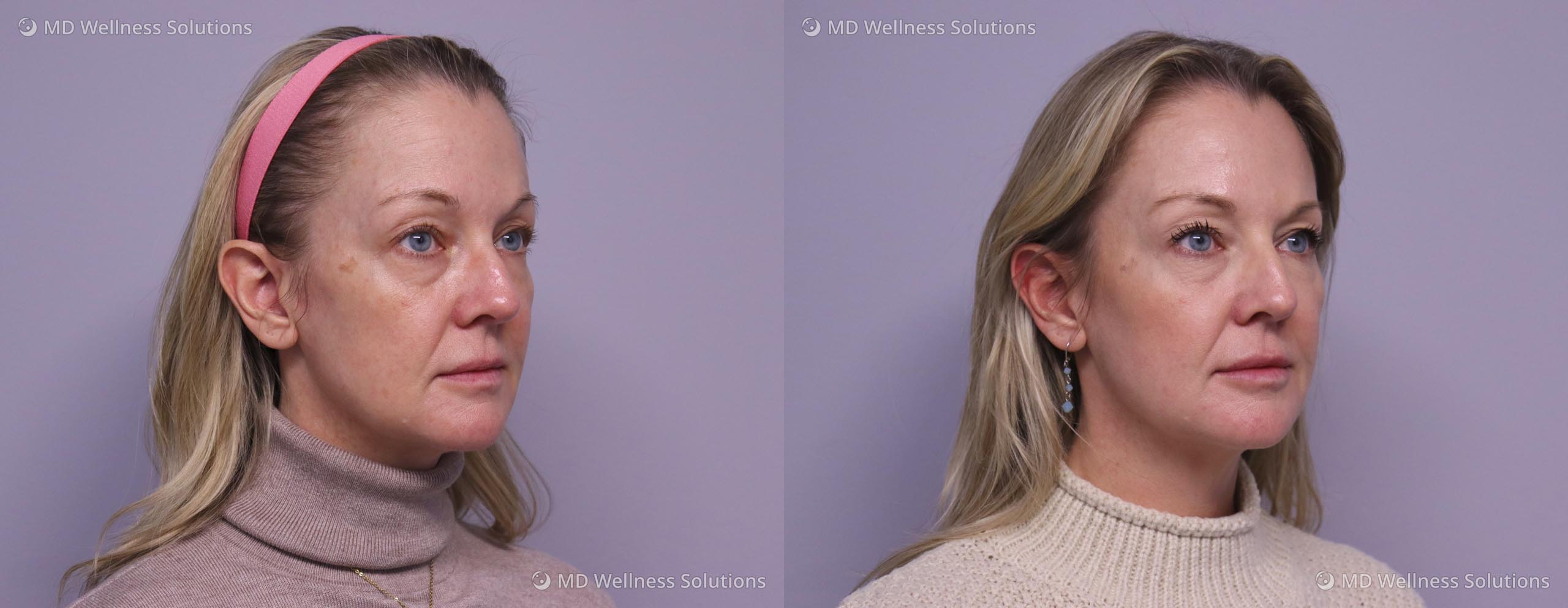 35-44 year old woman before and after Potenza microneedling treatment
