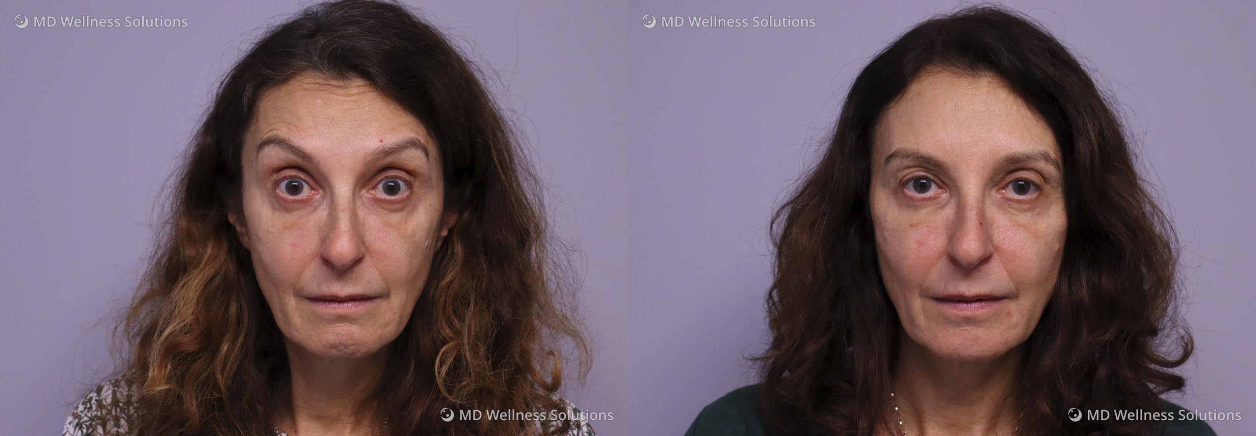 55-64 year old woman before and after neurotoxin treatment