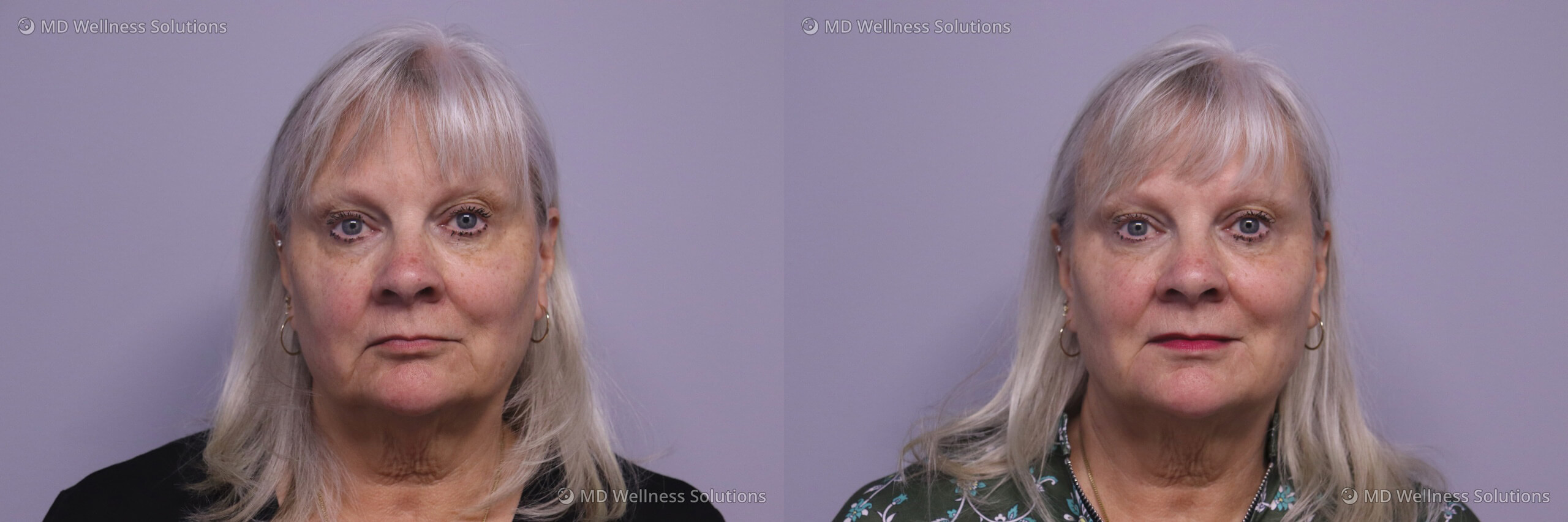 65-74 year old woman before and after Potenza radiofrequency microneedling treatment