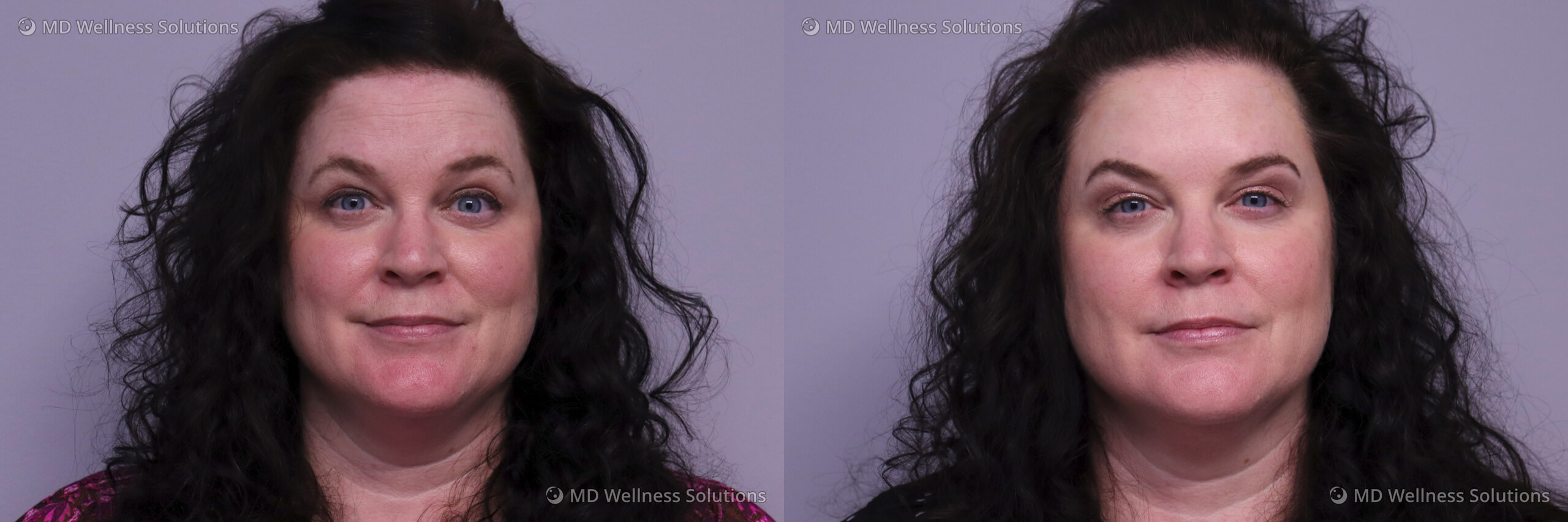 45-54 year old woman before and after neurotoxin treatment