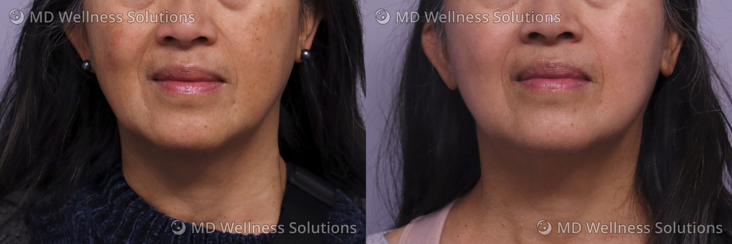55-64 year old woman before and after skincare treatment