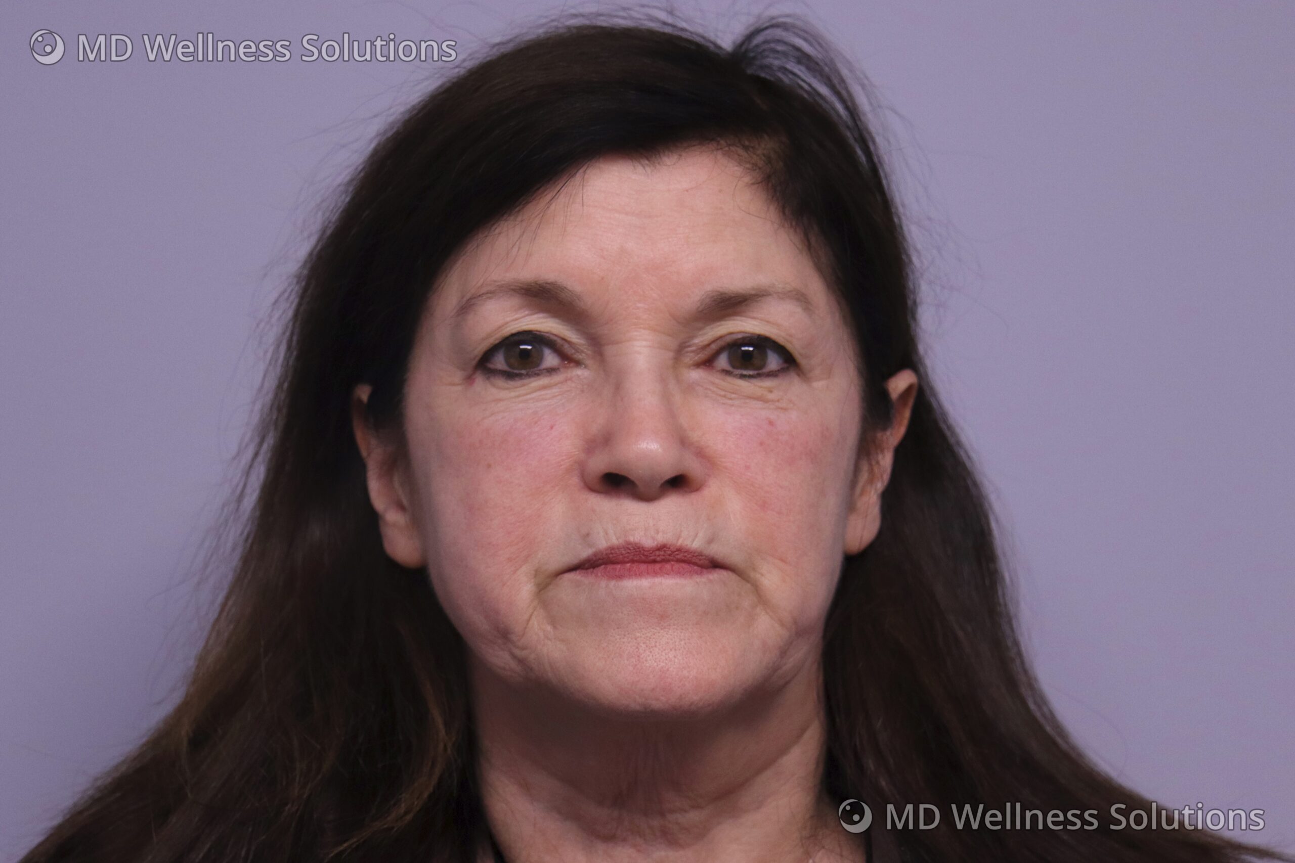 65-74 year old woman after dermal filler treatment